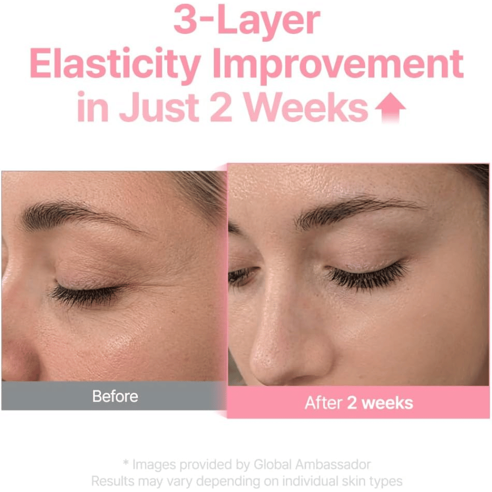 Ennen ja jälkeen -kuva Purito Multi PDRN Collagen EGF Serum -tuotteesta, joka osoittaa ihon kimmoisuuden parantuneen kahden viikon jälkeen.
